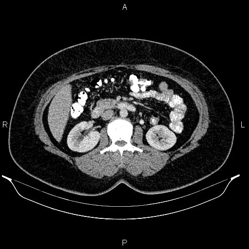 Bilateral ovarian dermoid cysts (Radiopaedia 85785-101603 A 49).jpg