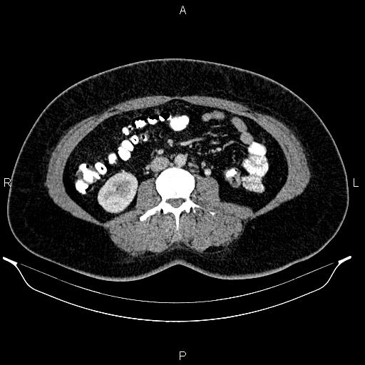 File:Bilateral ovarian dermoid cysts (Radiopaedia 85785-101603 A 57).jpg