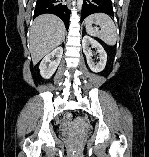 Bilateral ovarian dermoid cysts (Radiopaedia 85785-101603 C 40).jpg