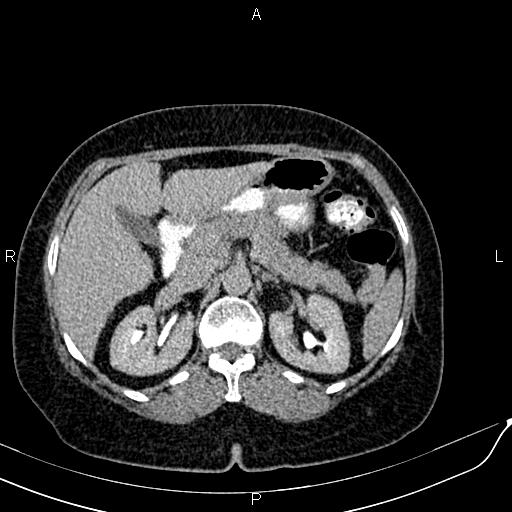 Bilateral ovarian serous cystadenocarcinoma (Radiopaedia 86062-101989 Axial C+ delayed 15).jpg