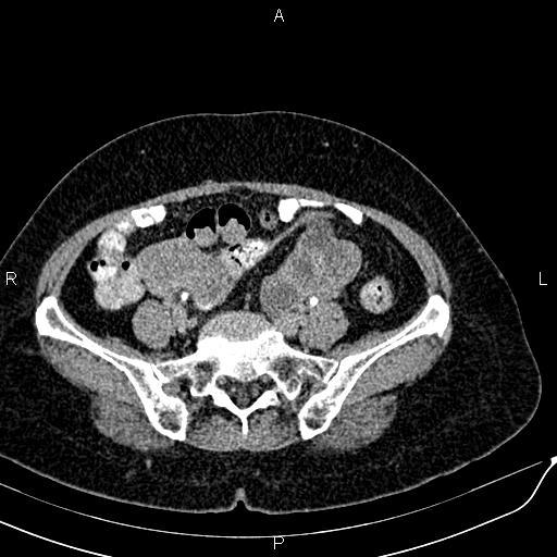 File:Bilateral ovarian serous cystadenocarcinoma (Radiopaedia 86062-101989 Axial C+ delayed 55).jpg