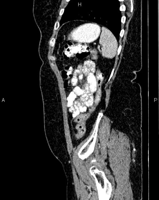 Bilateral ovarian serous cystadenocarcinoma (Radiopaedia 86062-101989 E 74).jpg