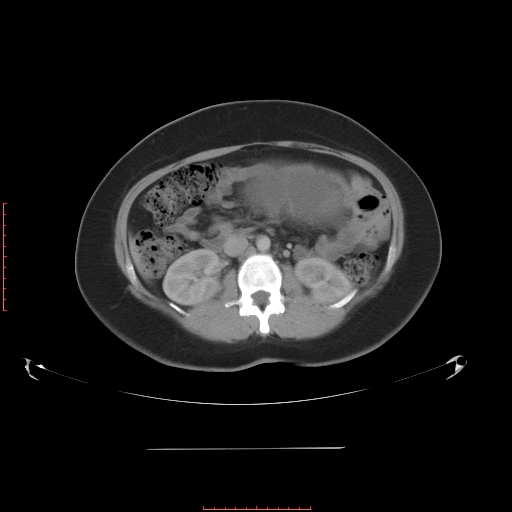 File:Bilateral ovarian serous cystadenocarcinoma with right ovarian torsion (Radiopaedia 32640-33611 A 18).jpg