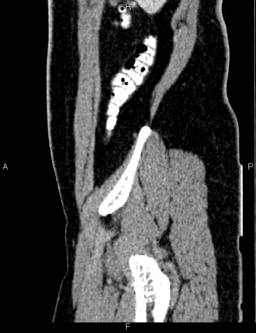 Bilateral ovarian teratoma (Radiopaedia 83131-97503 D 28).jpg