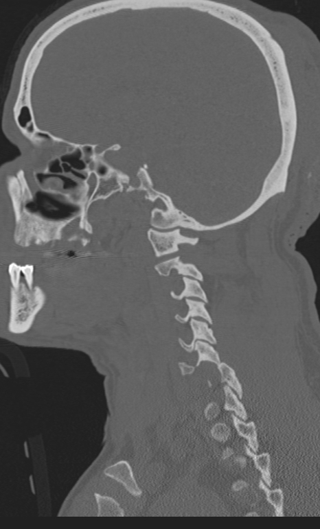 Bilateral perched facet joint (Radiopaedia 63149-71669 Sagittal bone window 4).jpg