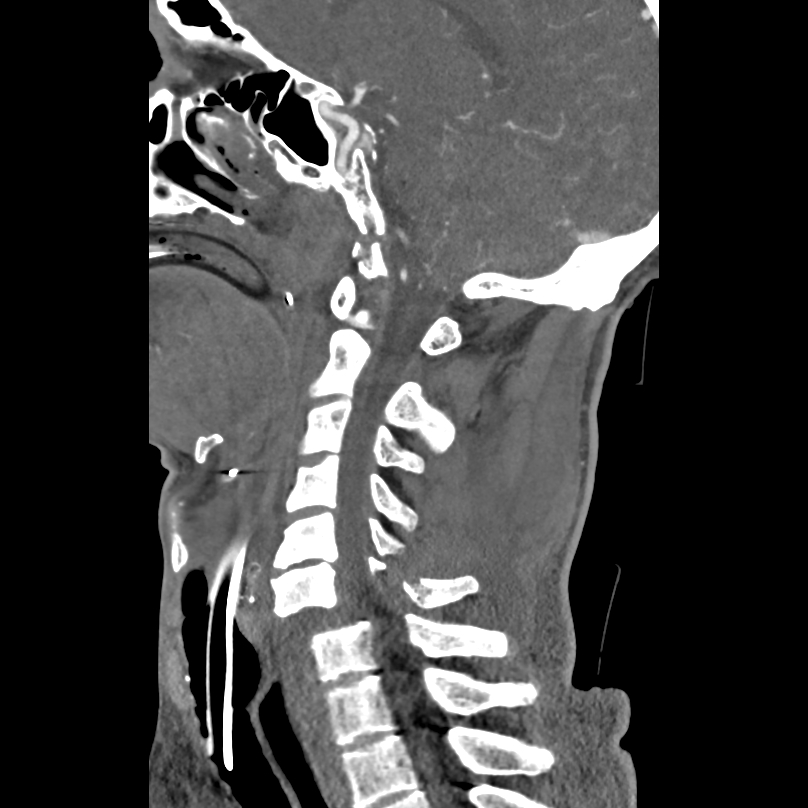 Bilateral perched facets with cord injury (Radiopaedia 45587-49713 B 28).jpg