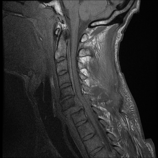 File:Bilateral perched facets with cord injury (Radiopaedia 45587-49714 Sagittal T1 8).jpg