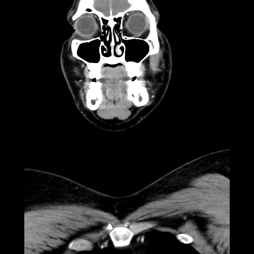 Bilateral peritonsillar abscess (Radiopaedia 85065-100610 Coronal 18).jpg