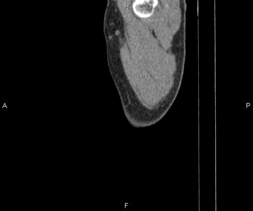 Bilateral pulmonary AVM (Radiopaedia 83134-97505 D 116).jpg