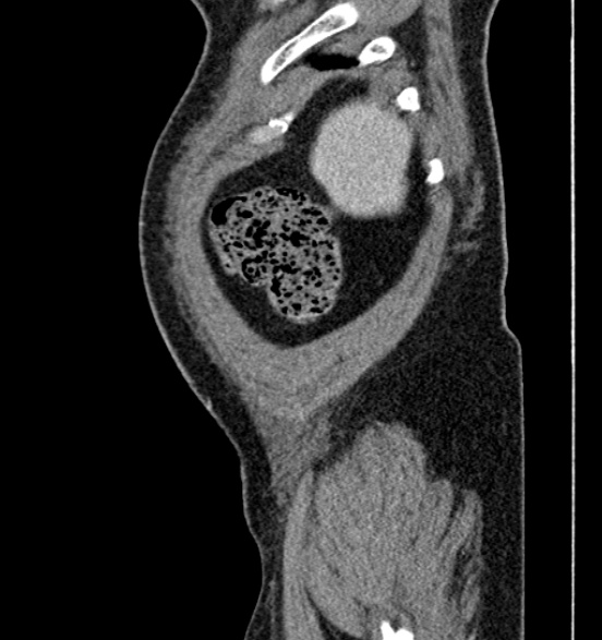 Bilateral rectus sheath hematomas (Radiopaedia 50778-56252 B 9).jpg