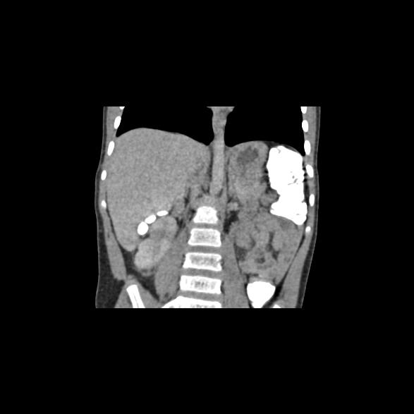 File:Bilateral renal malrotation (Radiopaedia 30901-31606 B 9).jpg