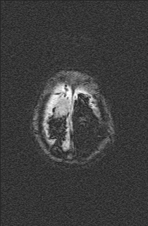 File:Bilateral subdural hemorrhage and parietal skull fracture (Radiopaedia 26058-26190 Axial SWI 77).png