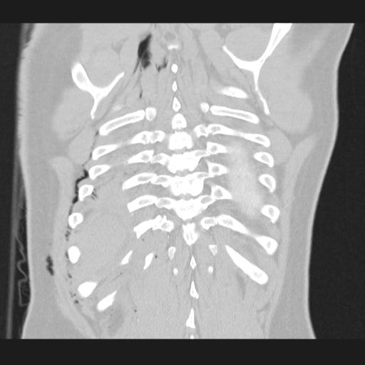 Bilateral traumatic renovascular injury (Radiopaedia 32051-32995 Coronal lung window 69).jpg
