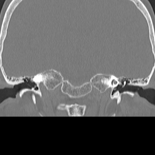 File:Bilateral tympanoplasty (Radiopaedia 16947-16664 Coronal bone window 8).jpg