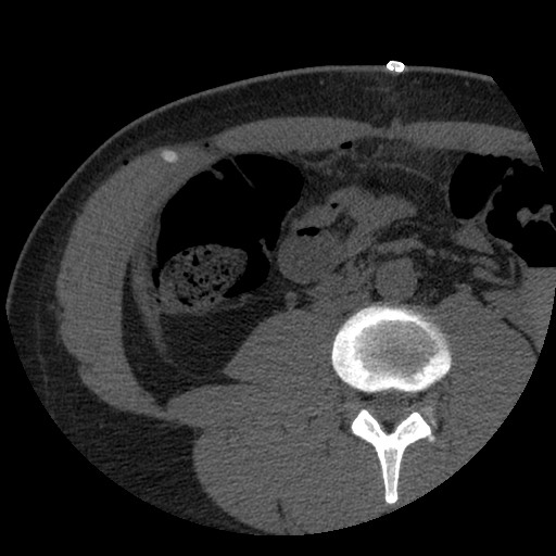 File:Bile leak from liver traumatic laceration (Radiopaedia 63463-72077 Axial Biliscopin 84).jpg