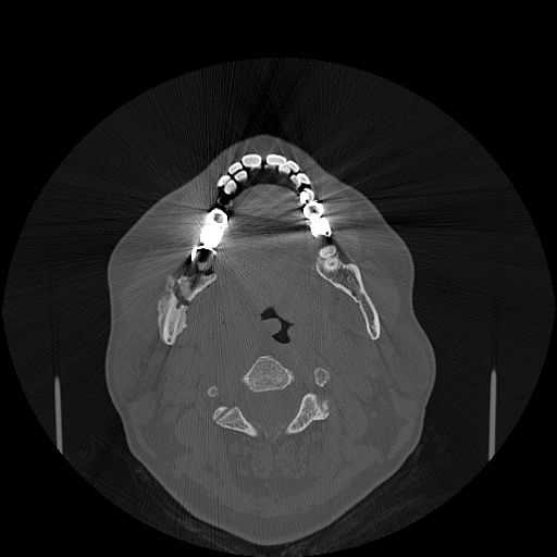 File:Bisphosphonate-related osteonecrosis of the jaw (Radiopaedia 71324-81642 Axial bone window 73).jpg