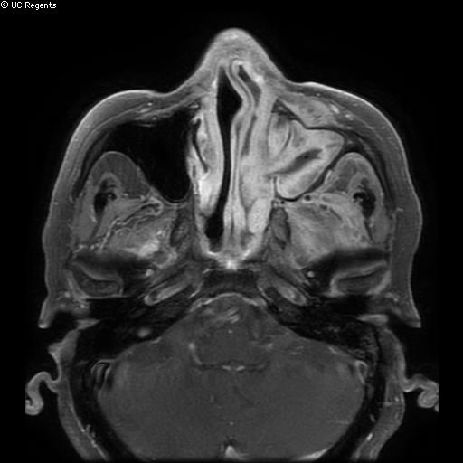 File:Bisphosphonate-related osteonecrosis of the maxilla (Radiopaedia 51367-57101 Axial T1 C+ fat sat 27).jpg