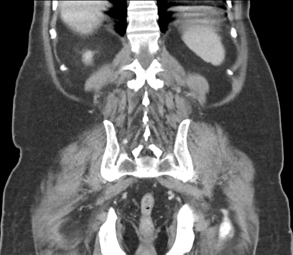 File:Bladder papillary urothelial carcinoma (Radiopaedia 48119-52951 C 51).png