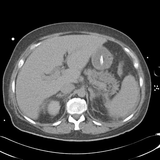 Bladder rupture post renal biopsy (Radiopaedia 30863-31572 Axial non-contrast 26).jpg