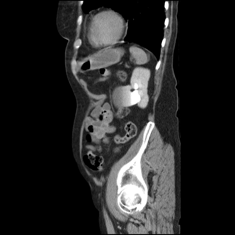 Bladder tumor detected on trauma CT (Radiopaedia 51809-57609 E 17).jpg