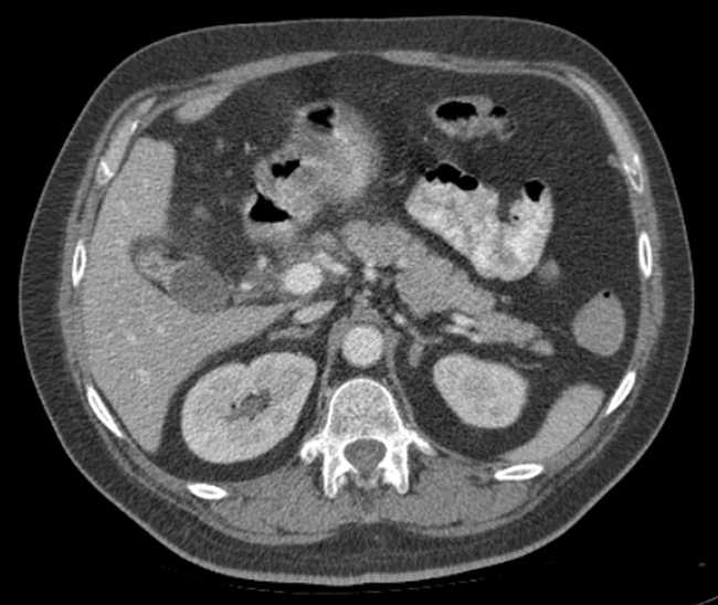 File:Bleeding duodenal ulcer and adenomyomatosis of gallbladder (Radiopaedia 61834-69861 A 34).jpg