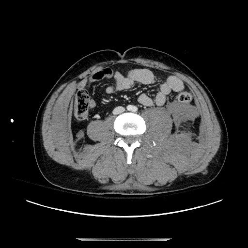 Blunt abdominal trauma with solid organ and musculoskelatal injury with active extravasation (Radiopaedia 68364-77895 A 89).jpg
