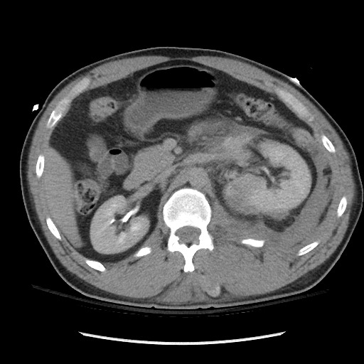 File:Blunt abdominal trauma with solid organ and musculoskelatal injury with active extravasation (Radiopaedia 68364-77895 Axial C+ delayed 52).jpg