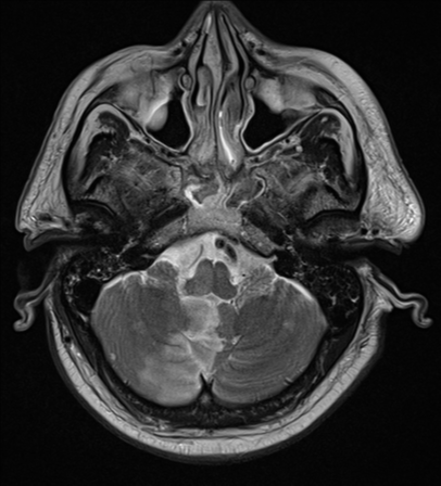 File:Blunt cerebrovascular injury (Radiopaedia 53682-59745 Axial T2 7).png