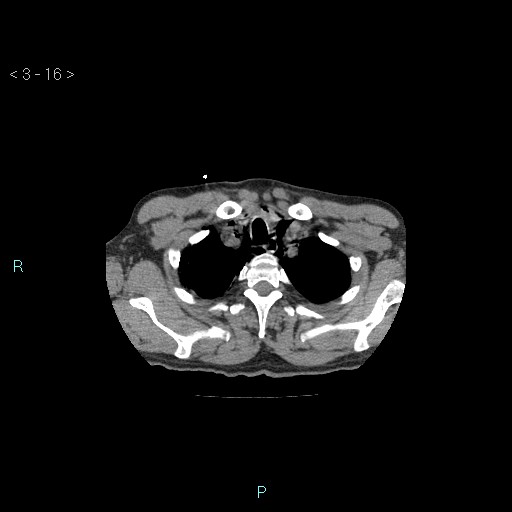 File:Boerhaave syndrome (Radiopaedia 27683-27897 Axial non-contrast 16).jpg