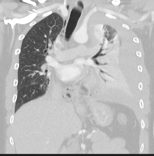 Boerhaave syndrome (Radiopaedia 39382-41661 Coronal lung window 24).png