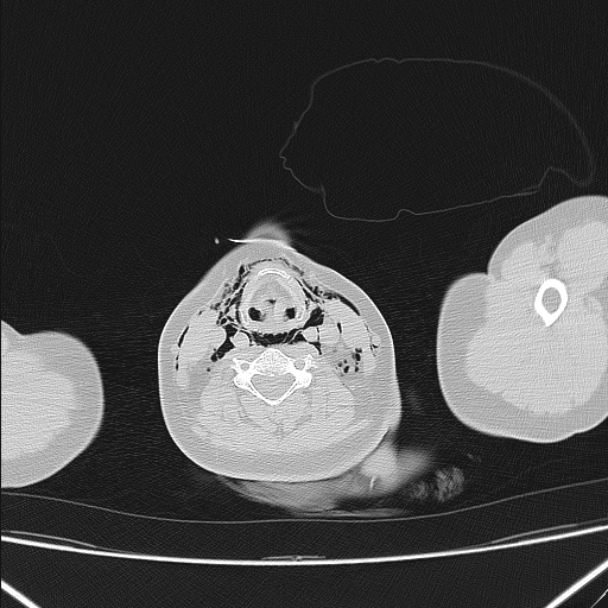 Boerhaave syndrome (Radiopaedia 45644-49799 Axial lung window 7).jpg