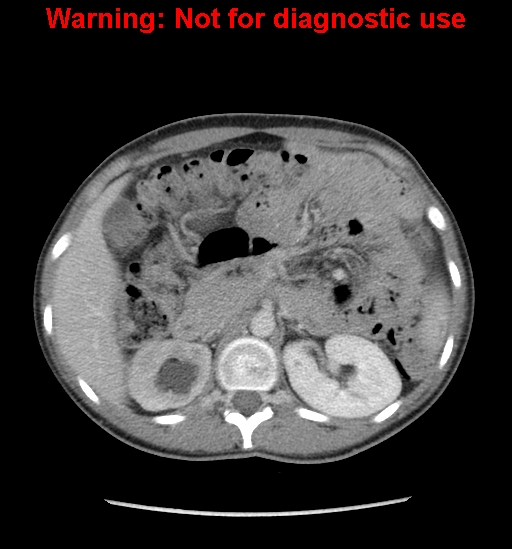 Borderline mucinous cystadenoma of ovary (Radiopaedia 25586-25767 A 2).jpg