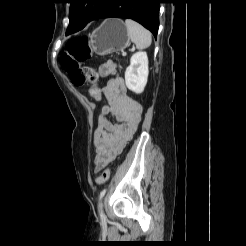Bosniak renal cyst - type IV (Radiopaedia 22929-22953 G 60).jpg