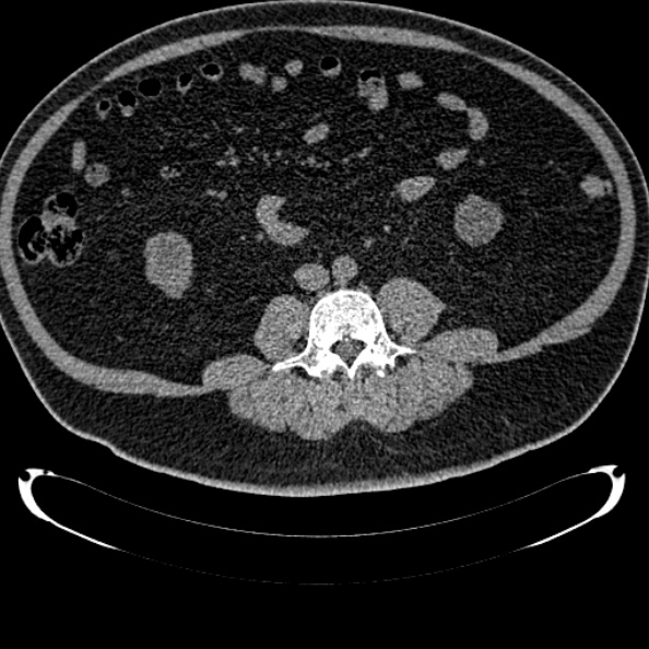 Bosniak renal cyst - type IV (Radiopaedia 24244-24518 Axial non-contrast 197).jpg