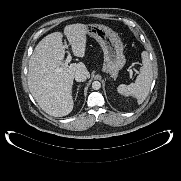 Bosniak renal cyst - type IV (Radiopaedia 24244-24518 C 67).jpg