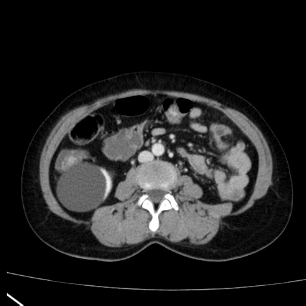 Bosniak renal cyst - type I (Radiopaedia 27479-27675 C 48).jpg