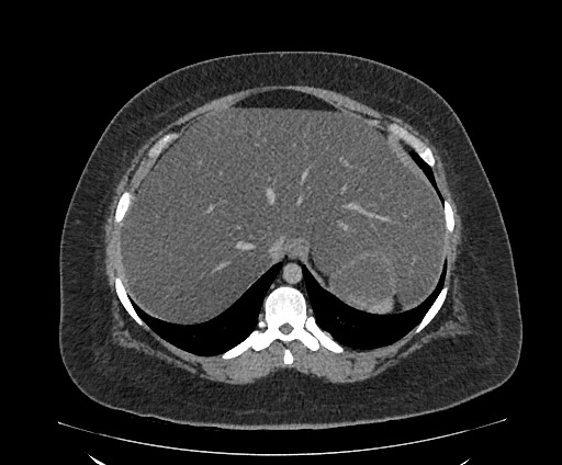 File:Bowel and splenic infarcts in acute lymphocytic leukemia (Radiopaedia 61055-68913 A 28).jpg