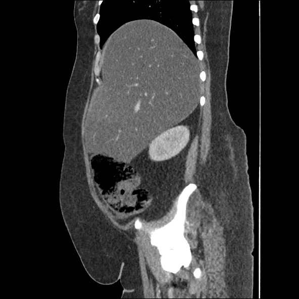Bowel and splenic infarcts in acute lymphocytic leukemia (Radiopaedia 61055-68915 C 50).jpg