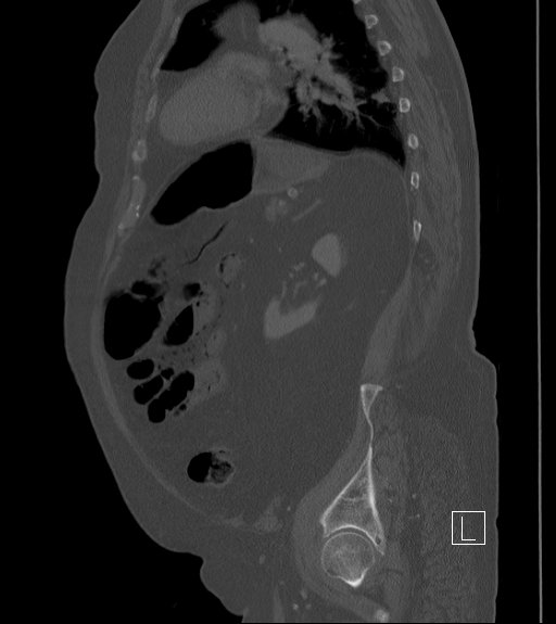 Bowel ischemia secondary to SMA occlusion with extensive portomesenteric venous gas (Radiopaedia 54656-60871 Sagittal bone window 31).jpg