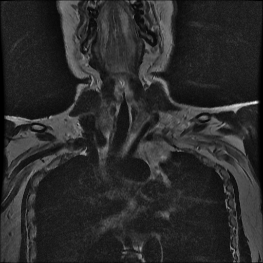File:Brachial plexus neurofibroma (Radiopaedia 28030-28291 Coronal T2 11).png