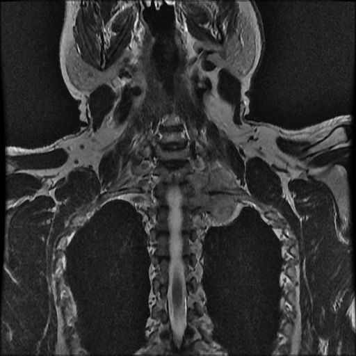 File:Brachial plexus neurofibroma (Radiopaedia 28030-28291 Coronal T2 3).png