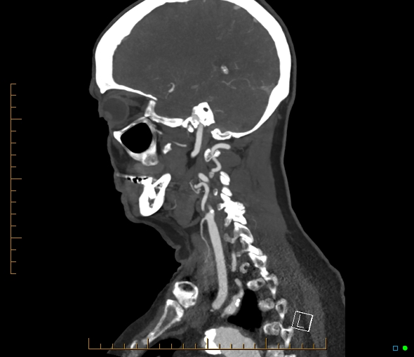 Brachiocephalic trunk stenosis (Radiopaedia 87242-103519 C 21).jpg