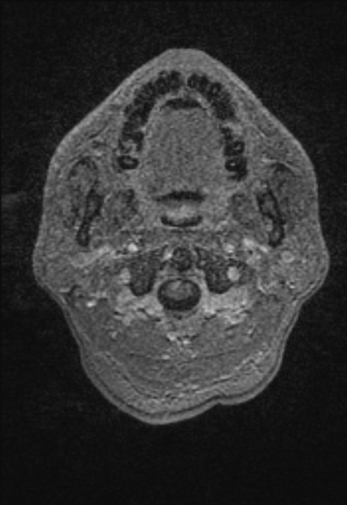 Brain abscess with ventriculitis (Radiopaedia 85703-101495 Axial T1 C+ 3).jpg