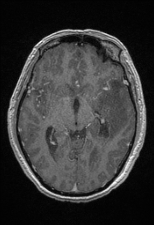 Brain abscess with ventriculitis (Radiopaedia 85703-101495 Axial T1 C+ 84).jpg