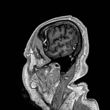 Brain metastases from lung cancer (Radiopaedia 83839-99028 Sagittal T1 C+ 4).jpg