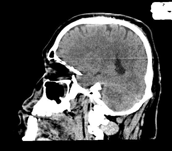 File:Brainstem hemorrhage (Radiopaedia 81294-94976 C 20).jpg