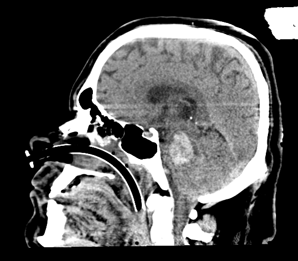 Brainstem hemorrhage (Radiopaedia 81294-94976 C 30).jpg