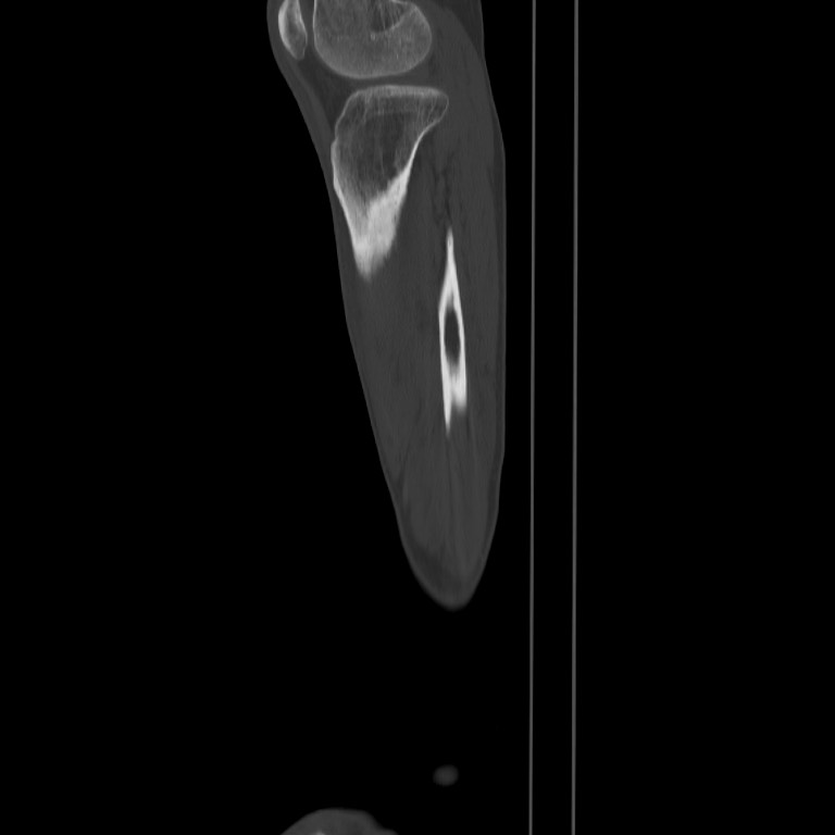 Brodie abscess - tibia (Radiopaedia 66028-75204 Sagittal bone window 63).jpg
