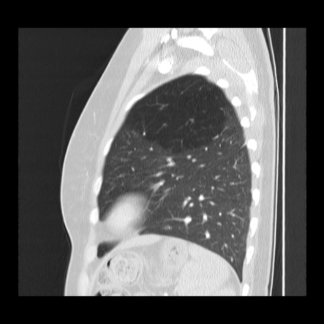 Bronchial atresia (Radiopaedia 22965-22992 Sagittal lung window 13).jpg