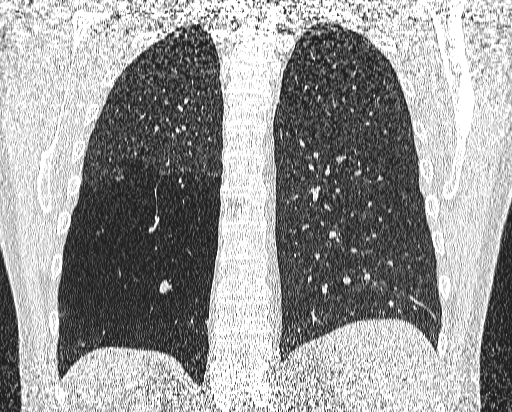 Bronchial atresia (Radiopaedia 58271-65417 Coronal lung window 44).jpg